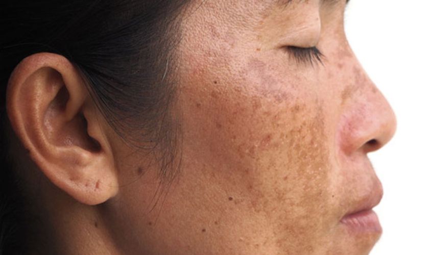 Debunking Common Myths About Melasma