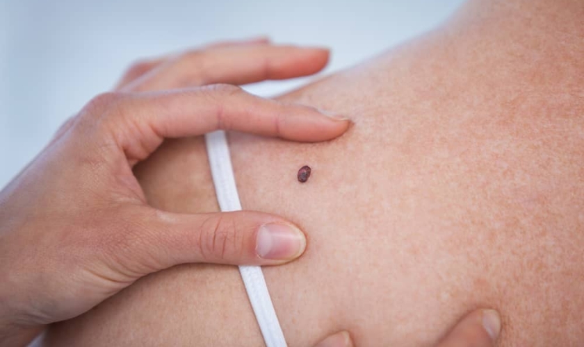 Moles and Skin Cancer: What You Need to Know