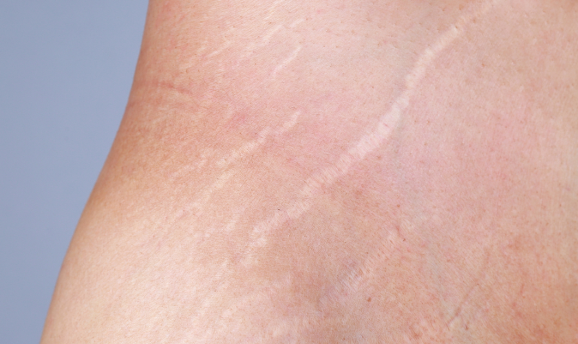 stretch marks alexandria