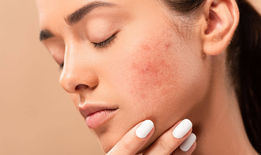 The Acne-Starring Revolution A New Era In Pimple Control