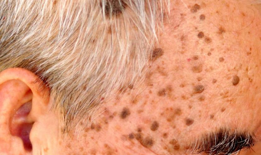 how to get rid of sebaceous keratosis