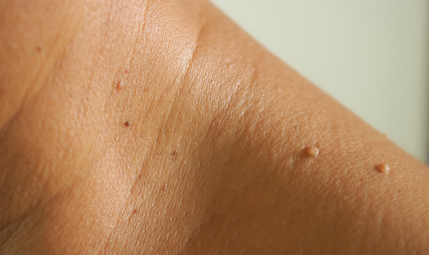 when should you worry about skin tags