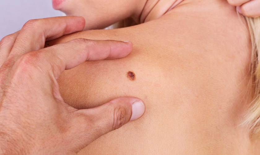 Is melanoma highly curable