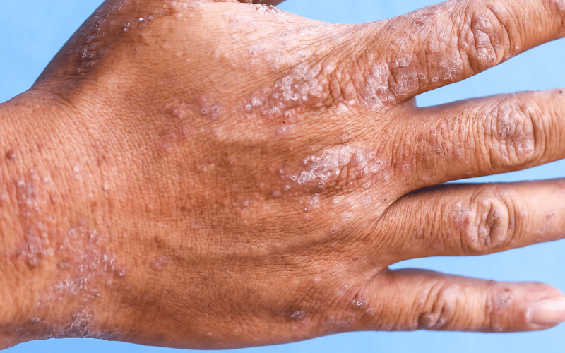 Is there a permanent cure for eczema