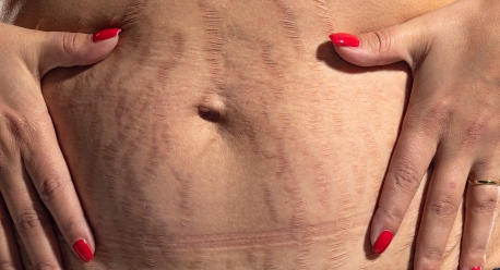 treatment options for stretch marks