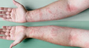 how-do-you-differentiate-eczema-from-other-skin-problems
