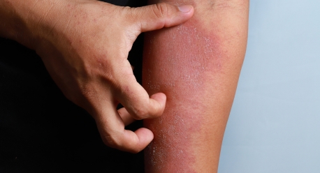 What is the root cause of eczema