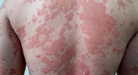 What Is The Fastest Treatment For Psoriasis