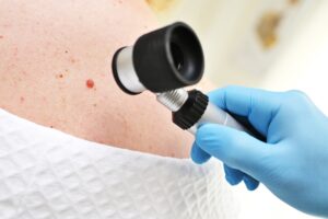 skin-cancer-treatment-in-Alexandria