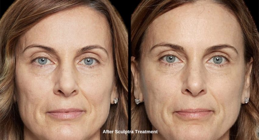 5-5-5 Rule After Sculptra