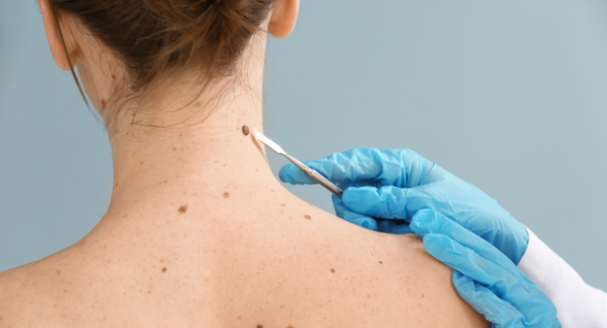 5 Myths About Skin Cancer Debunked