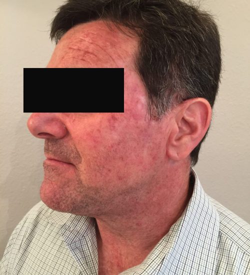 Actinic-Keratosis
