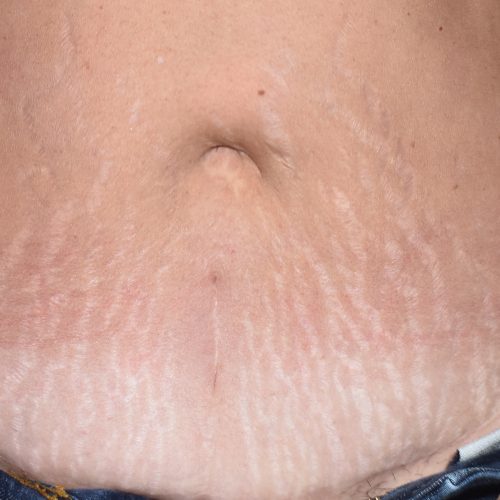 DSC_0015-8-stretch marks