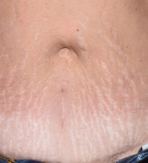 DSC_0015-8-stretch marks