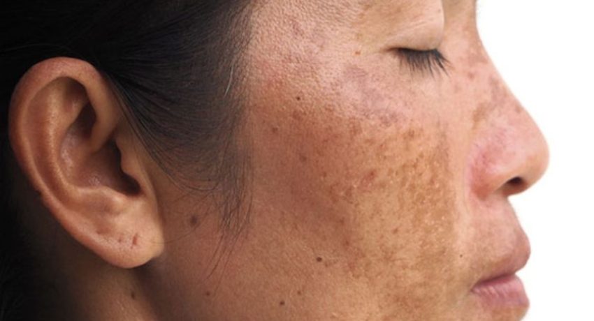Debunking Common Myths About Melasma