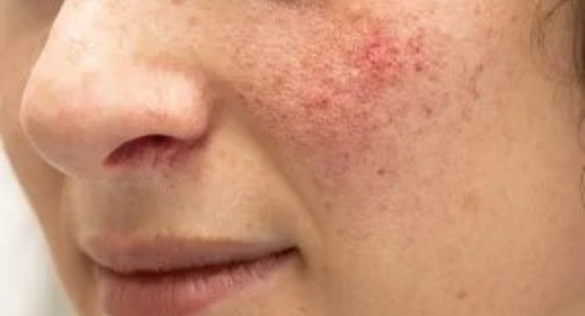 Deduct Rosacea From Your Routine With Targeted Treatment Options