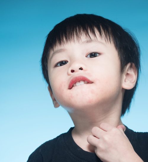 Asian boy got dairy or milk allergy got red skin rash around his month keep scratching blue background