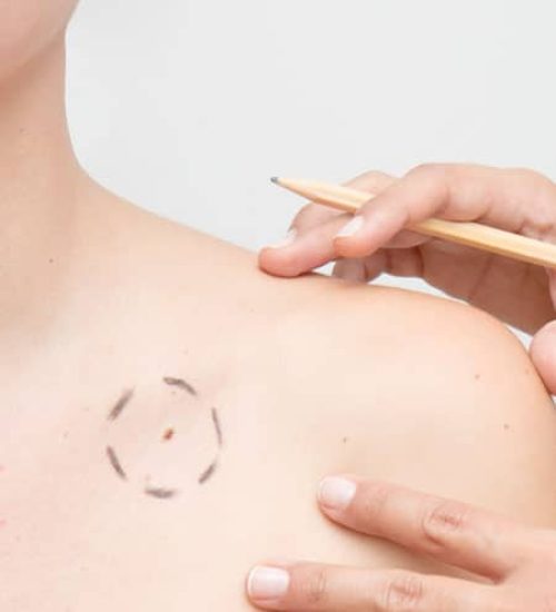 Effective-Treatment-for-Skin-Cancer