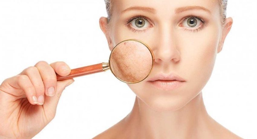 Melasma