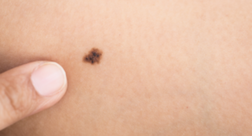 how long can you have skin cancer without knowing