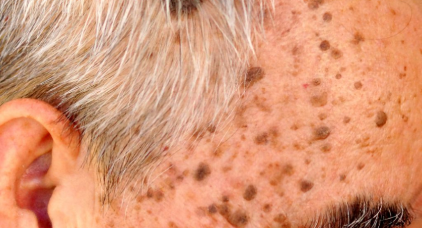how to get rid of sebaceous keratosis