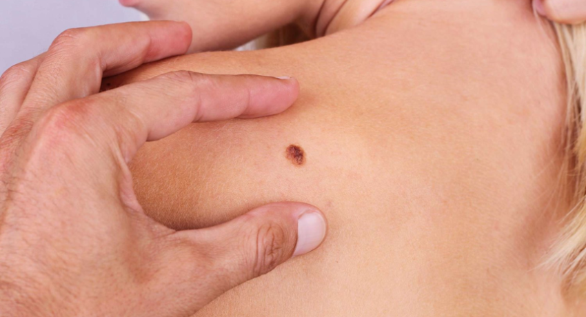 Is melanoma highly curable