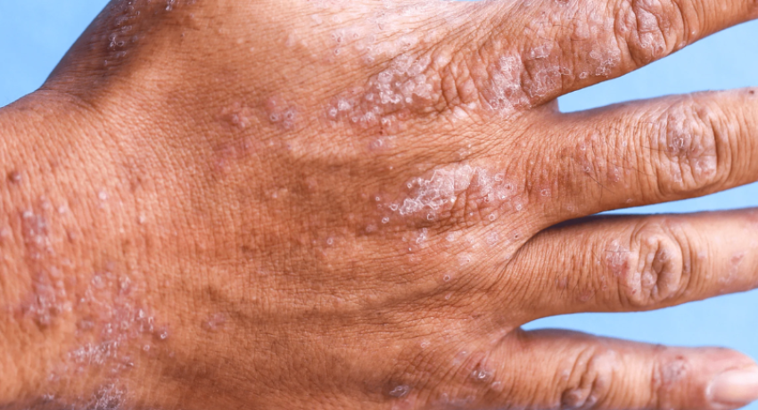 Is there a permanent cure for eczema