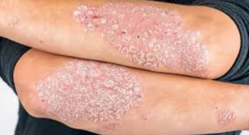 Lighten Up! Understanding Phototherapy For Psoriasis