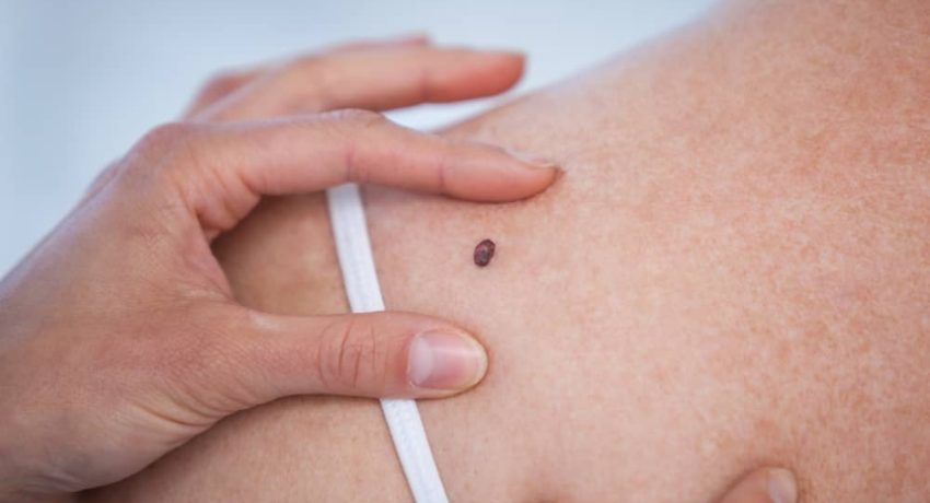 Moles and Skin Cancer: What You Need to Know