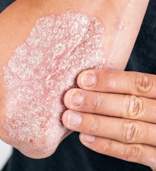 PSORIASIS