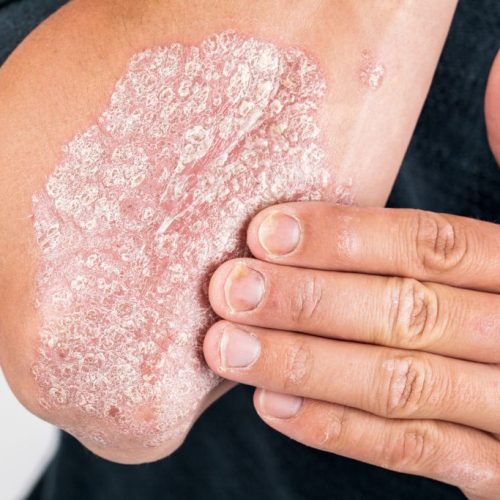 PSORIASIS
