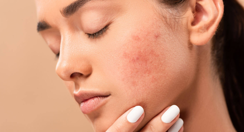 The Acne-Starring Revolution A New Era In Pimple Control