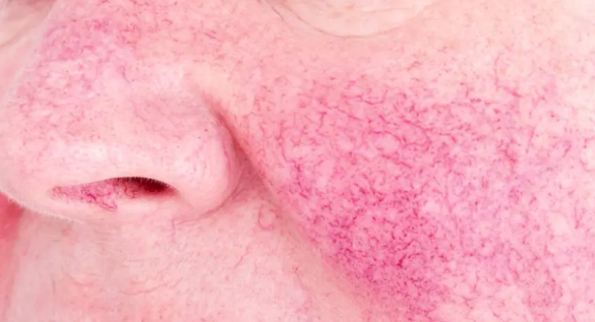 what causes broken blood vessels