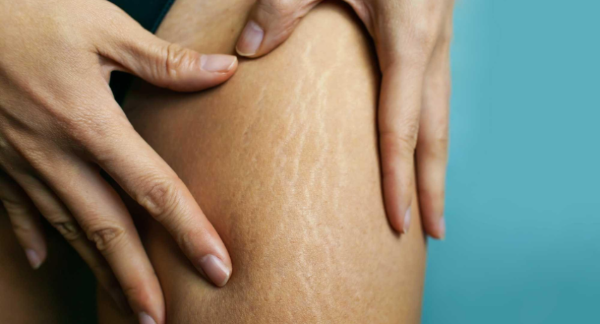 What causes stretch marks in