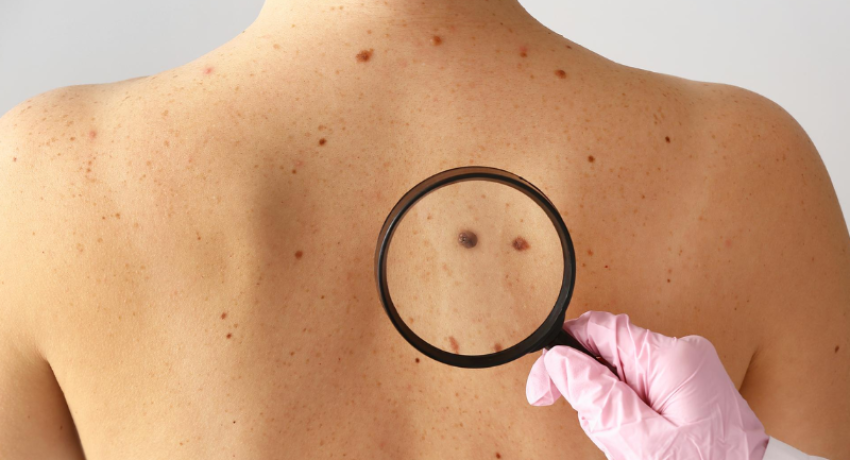 What is the best treatment for skin cancer