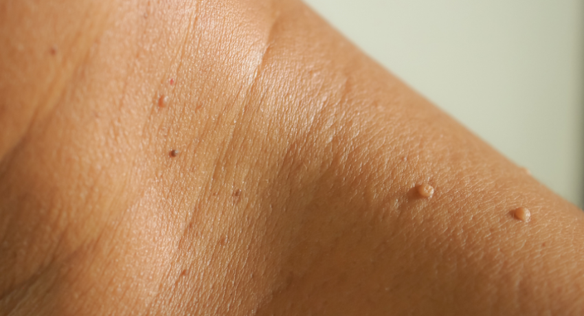 when should you worry about skin tags
