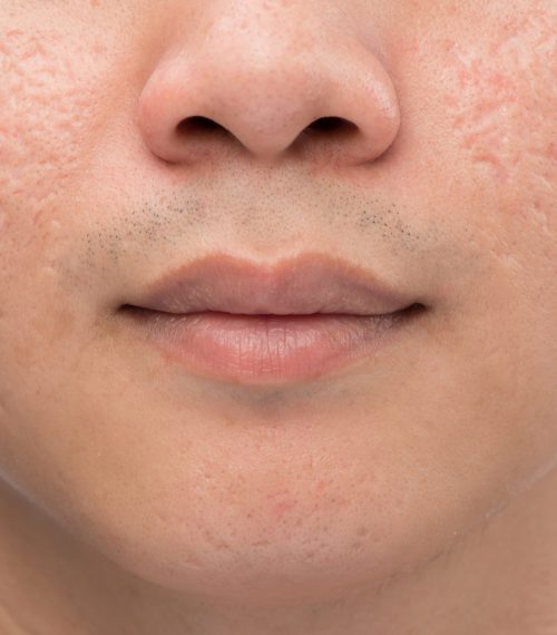 acne scarring