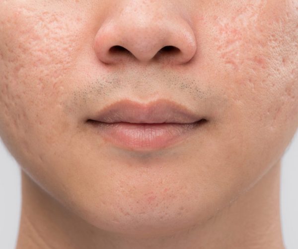 acne scarring
