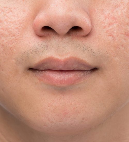 acne scarring