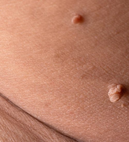 bigstock-Skin-Tag-Or-Acrochordon-Or-Sof-346661188-1024x683