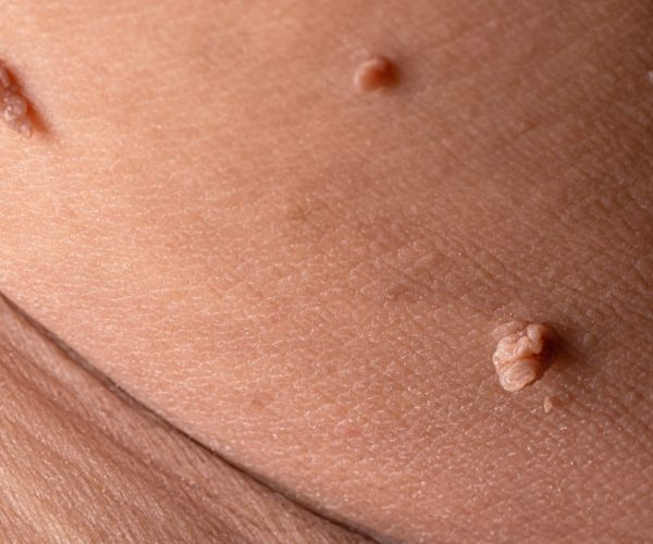 bigstock-Skin-Tag-Or-Acrochordon-Or-Sof-346661188-1024x683