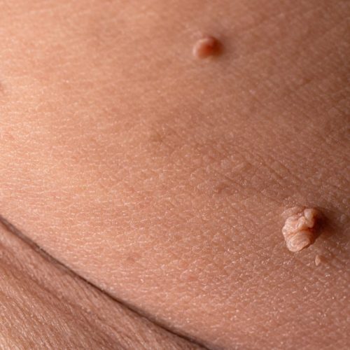 bigstock-Skin-Tag-Or-Acrochordon-Or-Sof-346661188-1024x683