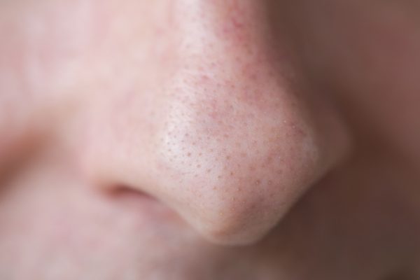 blackheads