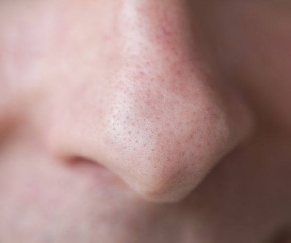 blackheads