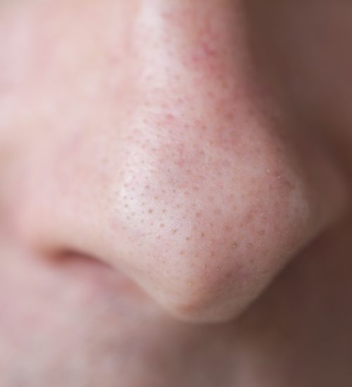 blackheads