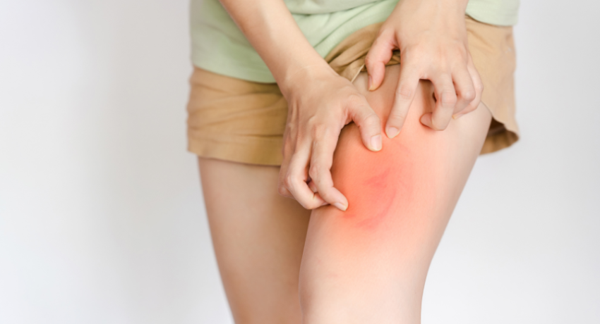 eczema alexandria