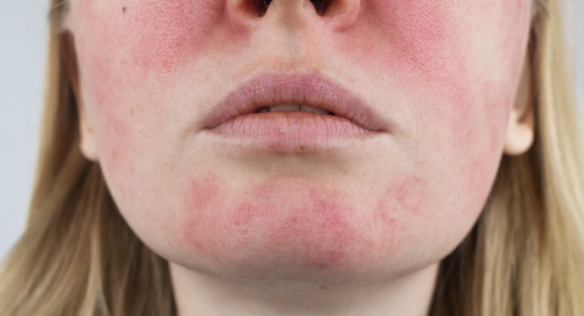 Managing Rosacea in Alexandria: Effective Tips and Treatments for Redness and Irritation