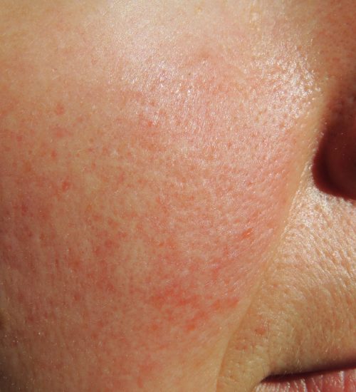 excel-v-and-rosacea-scaled
