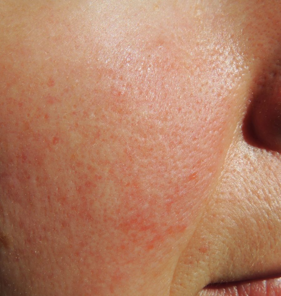 excel-v-and-rosacea-scaled