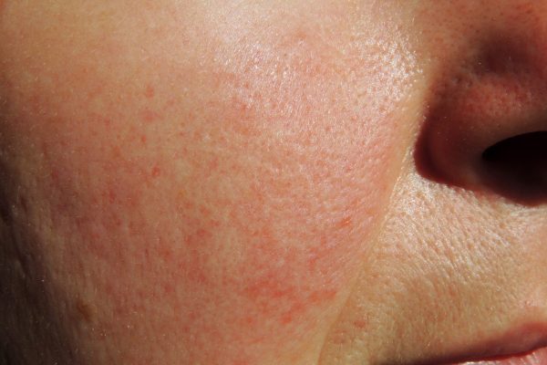 excel-v-and-rosacea-scaled